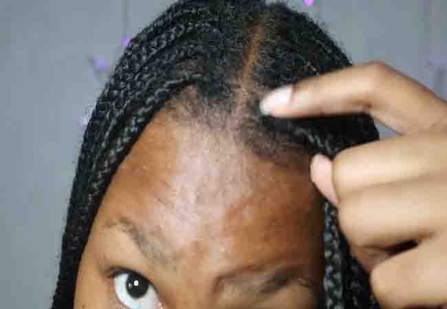 Causes of Baldness from Braids