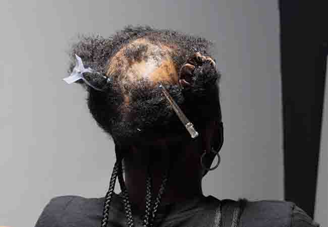 raction alopecia occurs due to continuous hair pulling